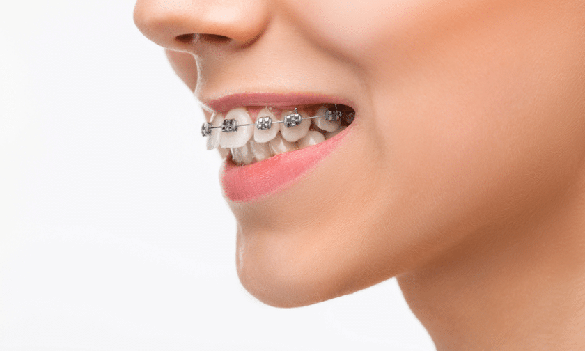 Important of Orthodontic braces Treatment for Straight Teeth