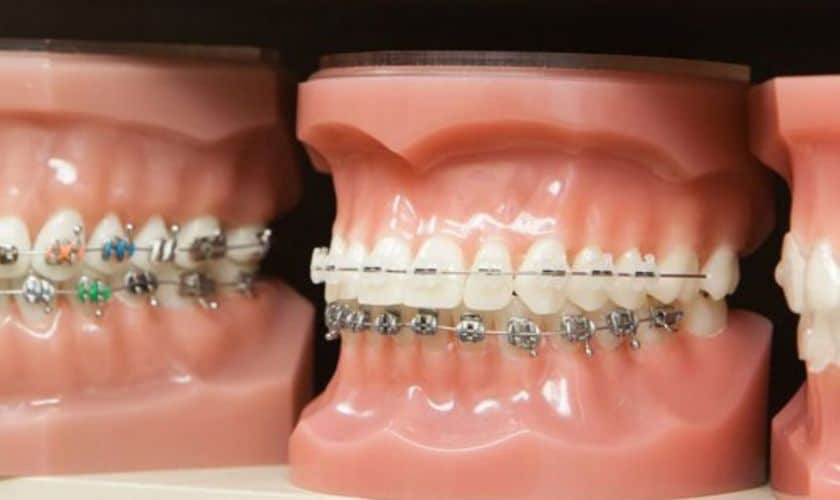 Ceramic Braces  Grant Orthodontics