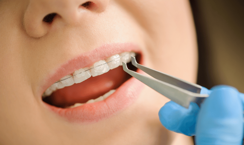 Ceramic Braces: Effective Solution for a Beautiful Smile