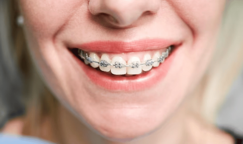 Orthodontics- Bracing for Braces - Elite Clinic