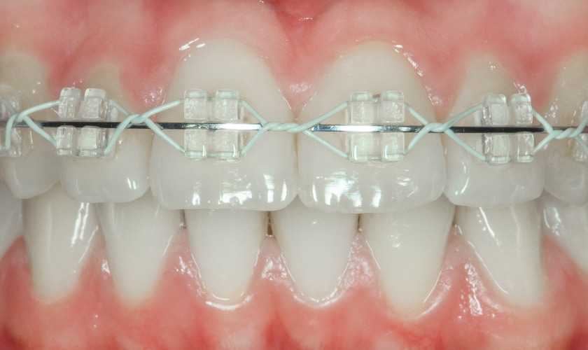 Teeth with Ceramic Braces: What You Need to Know