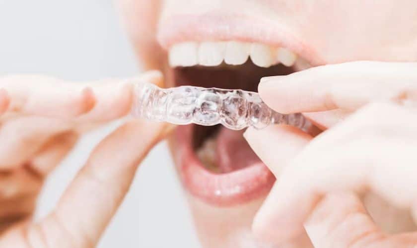 Beyond Metal Braces: Innovative Solutions for Adolescent Orthodontics
