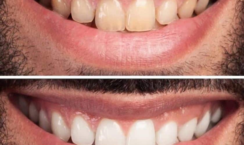 The Benefits of Professional Teeth Whitening Treatments