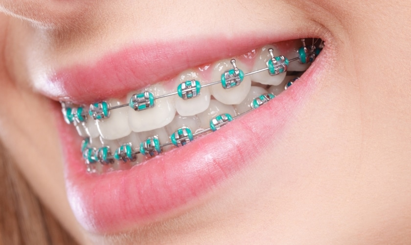 Is Your Smile Misaligned? How Can An Orthodontist Help?